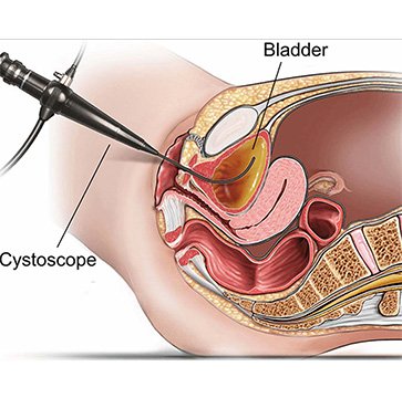 Cystoscopy Test